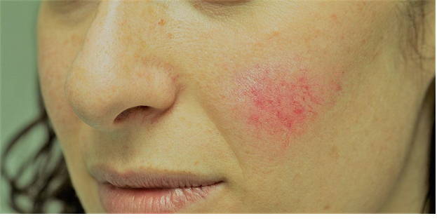 Red Light Therapy for Rosacea: Is Red Light the Key to Fighting Redness? - Rouge Care