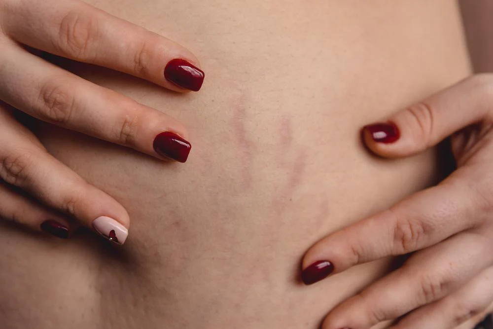 Red Light Therapy for Stretch Marks: How You Can Improve Your Skin’s Appearance - Rouge Care
