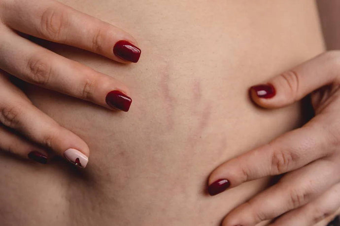 Red Light Therapy for Stretch Marks: How You Can Improve Your Skin’s Appearance